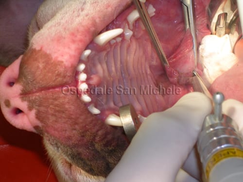 Asportazione del palato molle allungato mediante laser